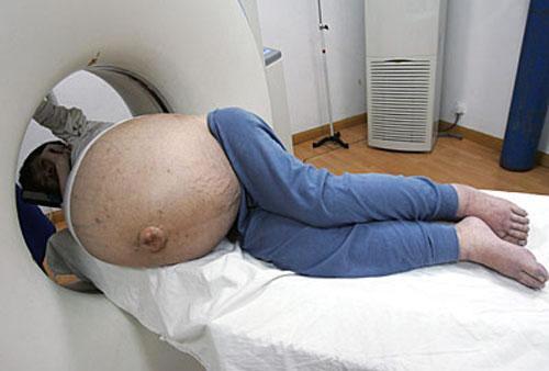 Китаянке отрезали 50-килограммовую опухоль