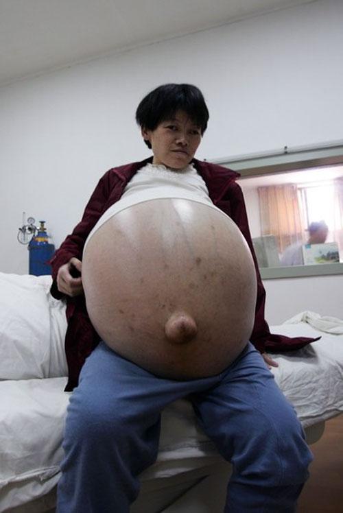 Китаянке отрезали 50-килограммовую опухоль