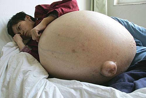 Китаянке отрезали 50-килограммовую опухоль