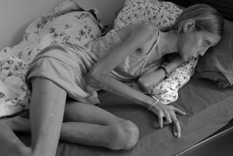 Изабель Каро: модель "с лицом трупа"