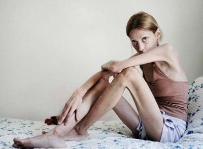 Изабель Каро: модель "с лицом трупа"