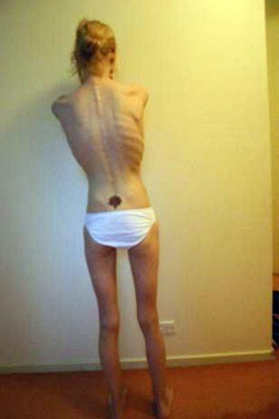 В лечении нервной анорексии ключевым элементом является психотерапия.