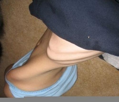 Среди них: выпадение волос, сухость и бледность кожного покрова, появление мелких волос на лице и на спине, а также нарушение структуры ногтей.