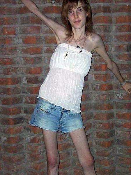 Самооценка больного анорексией зависит от фигуры и веса, причём вес оценивается не объективно.