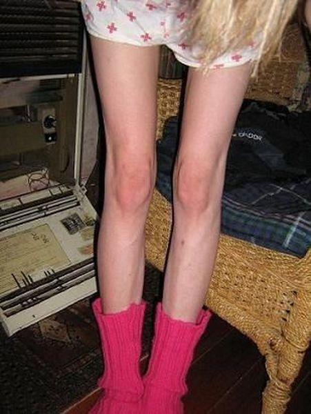 Также у больных анорексией наблюдаются проблемы с менструальным циклом, сердечная аритмия, постоянная слабость и мышечные спазмы.