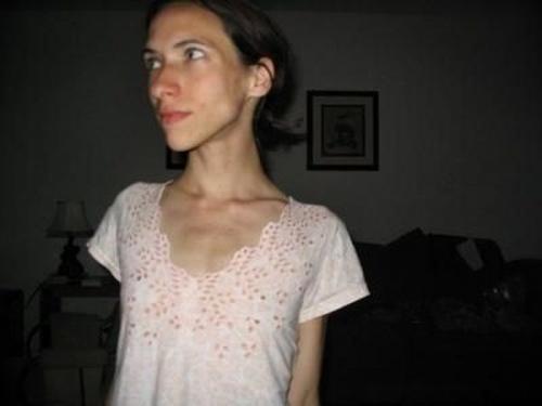 Одним из опасных для здоровья следствий анорексии является самоназначение и чрезмерный приём гормональных препаратов.