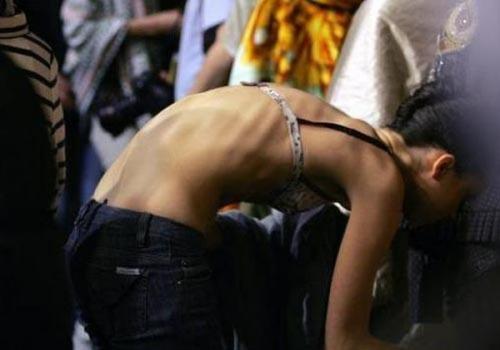 Чаще всего заболевание встречается у девушек возрастом от 13 до 25 лет.