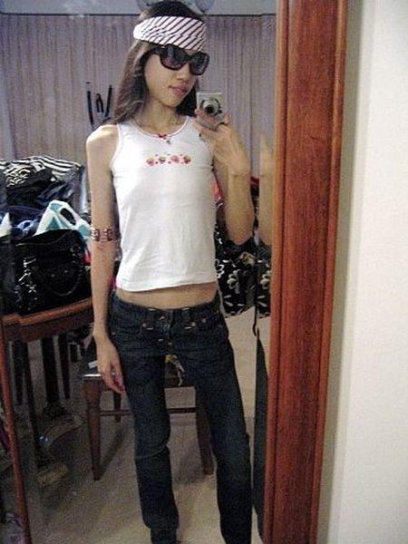 Внешнему виду больных анорексия также не оставляет шансов: первые признаки болезни включают в себя явные кожные нарушения.