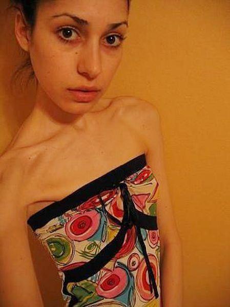 Однако гораздо более страшные последствия анорексии происходят внутри организма.