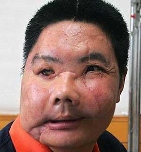 Китайскому охотнику пересадили лицо