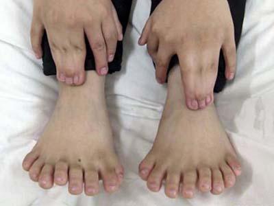 24 марта 2010 года китайские врачи провели успешную процедуру по удалению лишних пальцев на руках и ногах 6-летнему мальчику. До операции на конечностях необычного ребенка можно было насчитать в общей сложности 31 палец.