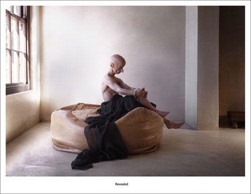 Редкая болезнь художника сделала его похожим на инопланетянина