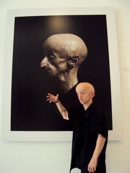 Редкая болезнь художника сделала его похожим на инопланетянина