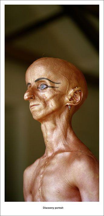 Редкая болезнь художника сделала его похожим на инопланетянина