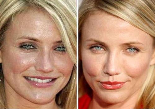 Звёзды ведут борьбу за безупречные носы