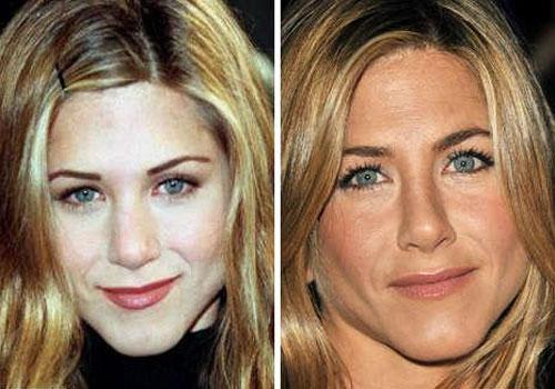 Звёзды ведут борьбу за безупречные носы