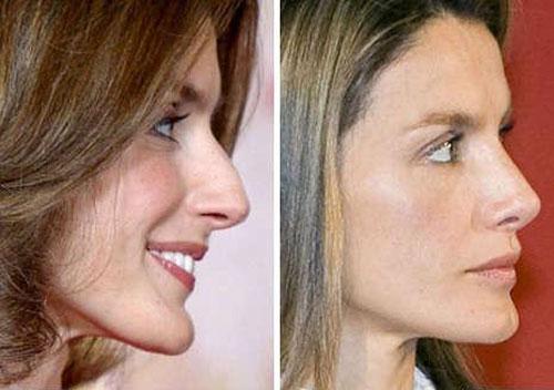 Звёзды ведут борьбу за безупречные носы