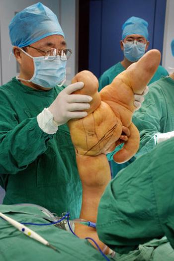 Прооперировали человека с самой большой рукой в мире