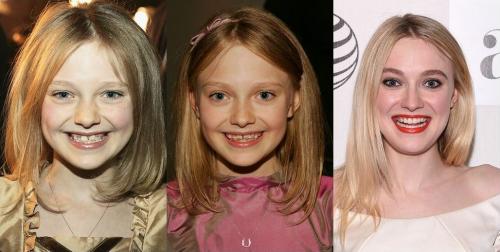 Знаменитости, которым брекеты кардинально сменили улыбку