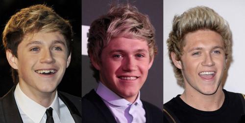 Знаменитости, которым брекеты кардинально сменили улыбку