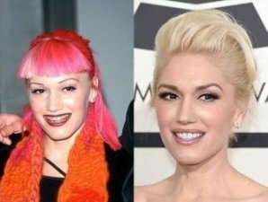 Знаменитости, которым брекеты кардинально сменили улыбку