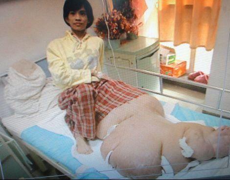 Самые гигантские опухоли на теле человека