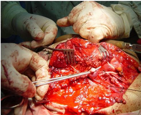 Самые гигантские опухоли на теле человека