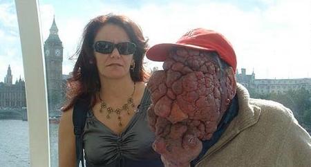 Самые гигантские опухоли на теле человека