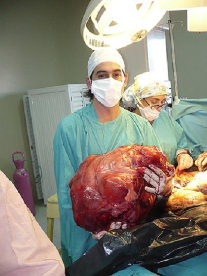 Самые гигантские опухоли на теле человека