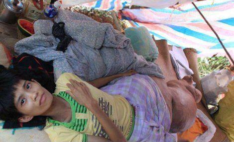 Самые гигантские опухоли на теле человека