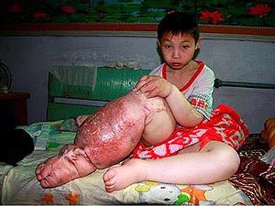 Самые гигантские опухоли на теле человека