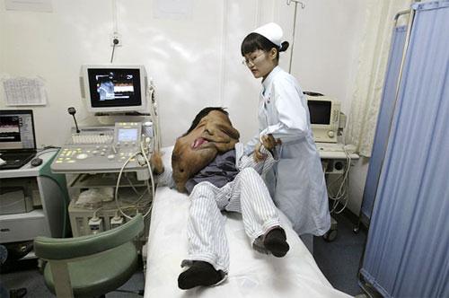 Самые гигантские опухоли на теле человека