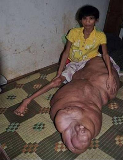Самые гигантские опухоли на теле человека