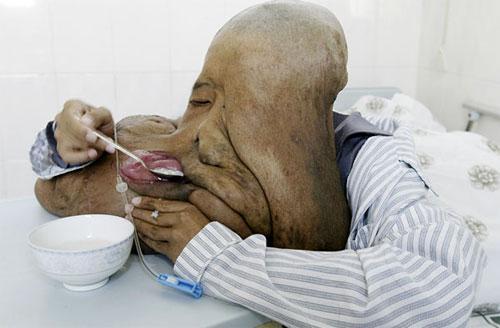 Самые гигантские опухоли на теле человека