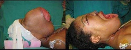 Самые гигантские опухоли на теле человека