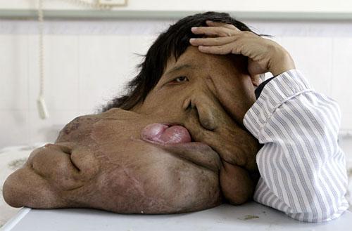 Самые гигантские опухоли на теле человека