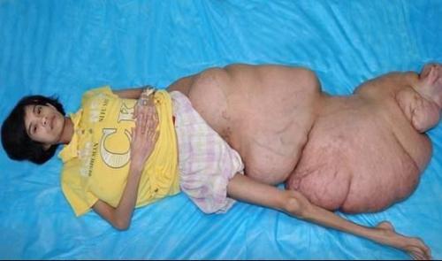 Самые гигантские опухоли на теле человека