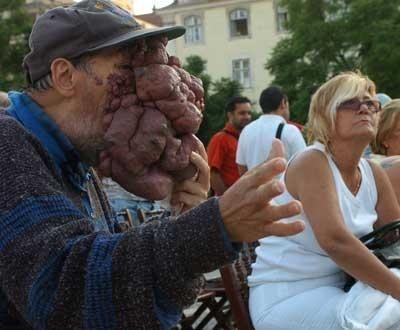 Самые гигантские опухоли на теле человека