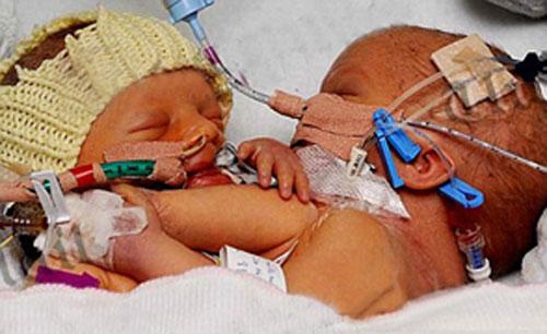 В Англии родились сиамские близнецы сросшиеся грудью