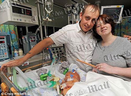 В Англии родились сиамские близнецы сросшиеся грудью