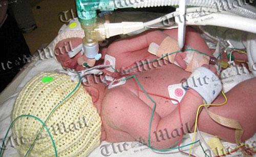 В Англии родились сиамские близнецы сросшиеся грудью