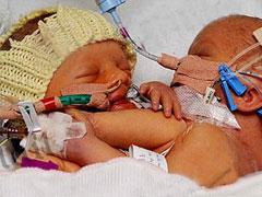 В Англии родились сиамские близнецы сросшиеся грудью