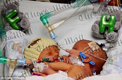 В Англии родились сиамские близнецы сросшиеся грудью