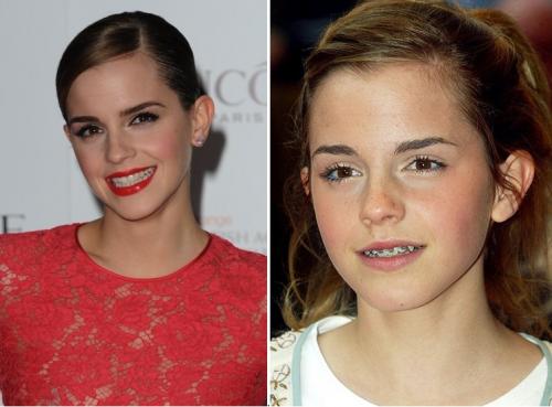 Знаменитости, которые носили брекеты