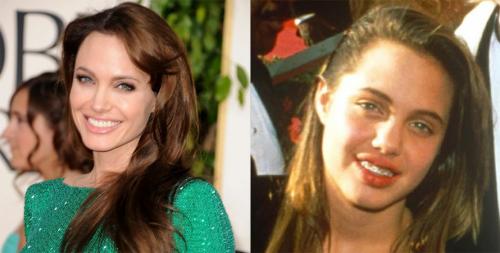 Знаменитости, которые носили брекеты