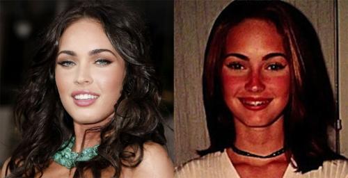 Знаменитости, которые носили брекеты