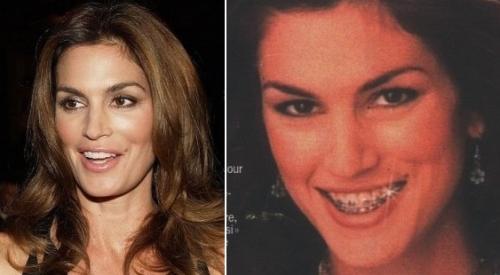 Знаменитости, которые носили брекеты