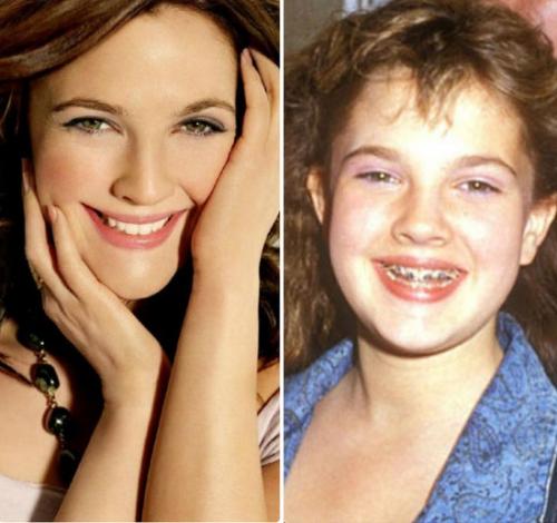 Знаменитости, которые носили брекеты