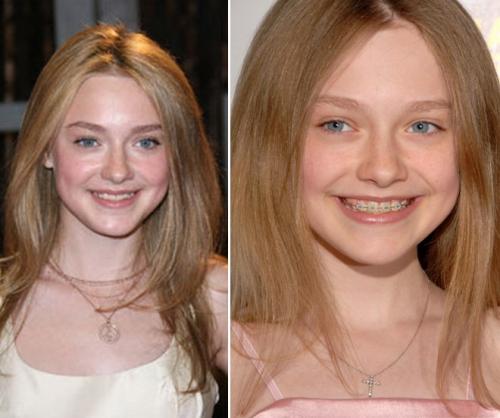 Знаменитости, которые носили брекеты