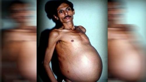 15 самых жутких реальных историй о близнецах